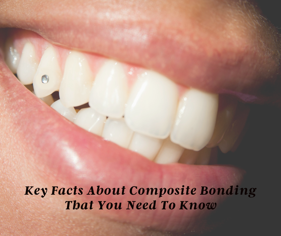 Key Facts About Composite Bonding That You Need To Know